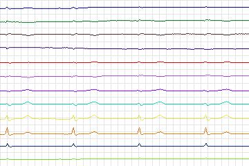 s0017lre-patient003 thumbnail