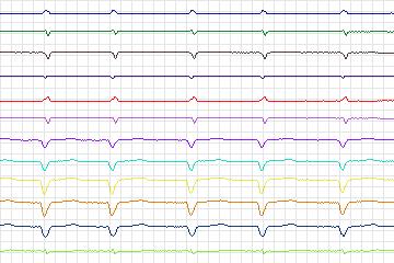 s0018lre-patient113 thumbnail
