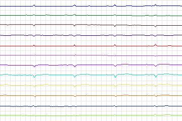 s0022lre-patient006 thumbnail