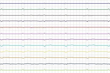 s0025lre-patient005 thumbnail