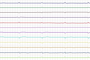 s0027lre-patient006 thumbnail