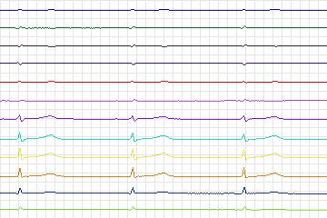 s0028lre-patient008 thumbnail