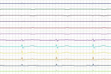 s0037lre-patient008 thumbnail