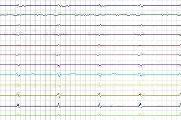 s0039lre-patient011 thumbnail