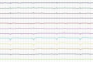 s0042lre-patient010 thumbnail