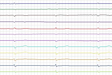 s0043lre-patient012 thumbnail
