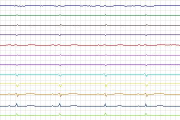 s0044lre-patient011 thumbnail