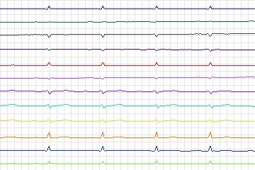 s0053lre-patient017 thumbnail