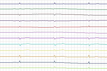 s0055lre-patient017 thumbnail