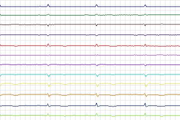 s0056lre-patient014 thumbnail