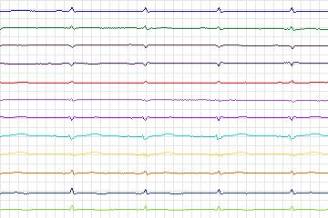 s0058lre-patient019 thumbnail