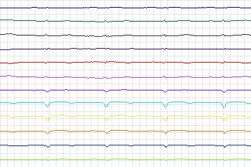s0061lre-patient010 thumbnail