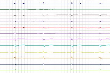 s0063lre-patient017 thumbnail