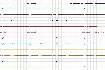 s0064lre-patient006 thumbnail