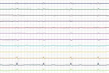 s0065lre-patient021 thumbnail