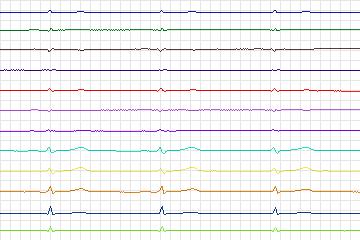 s0066lre-patient022 thumbnail