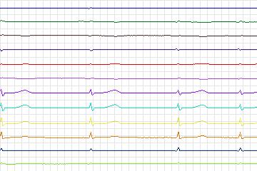 s0068lre-patient008 thumbnail