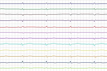 s0070lre-patient019 thumbnail