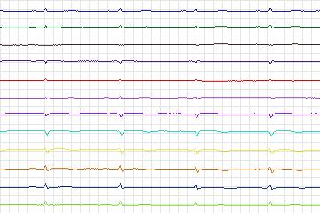 s0072lre-patient013 thumbnail
