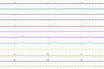 s0075lre-patient017 thumbnail