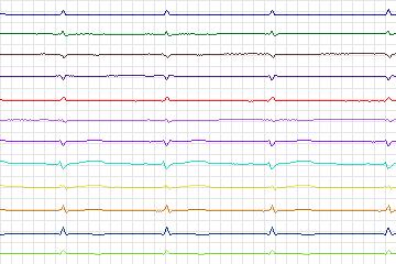 s0077lre-patient019 thumbnail