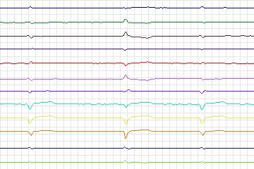 s0087lre-patient025 thumbnail