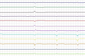 s0091lre-patient025 thumbnail