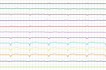 s0096lre-patient027 thumbnail