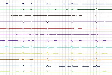 s0100lre-patient031 thumbnail