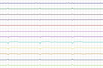 s0101lre-patient005 thumbnail