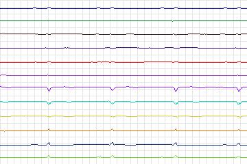 s0105lre-patient033 thumbnail