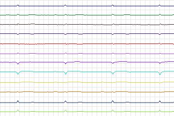 s0116lre-patient036 thumbnail