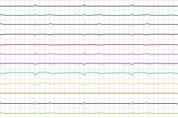 s0120lre-patient037 thumbnail