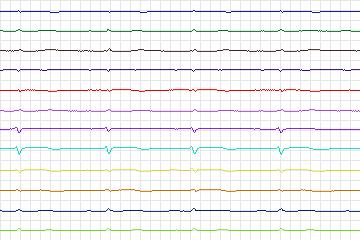 s0125lre-patient038 thumbnail