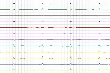 s0127lre-patient031 thumbnail