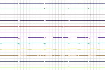s0129lre-patient039 thumbnail