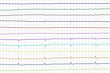 s0130lre-patient040 thumbnail