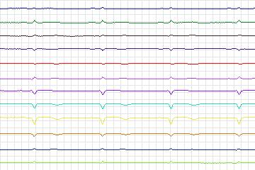 s0140lre-patient042 thumbnail