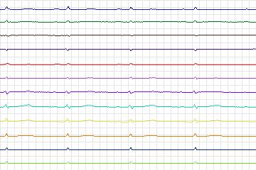 s0141lre-patient043 thumbnail