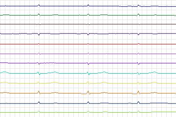 s0144lre-patient043 thumbnail