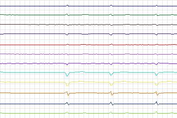 s0150lre-patient025 thumbnail