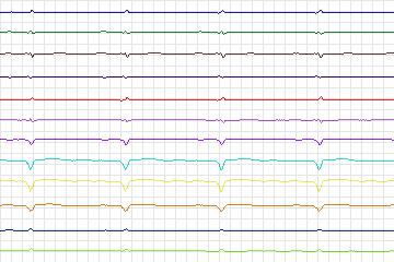 s0151lre-patient027 thumbnail
