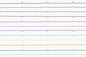 s0152lre-patient015 thumbnail