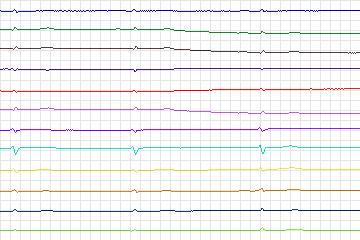 s0162lre-patient038 thumbnail