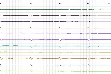s0164lre-patient039 thumbnail