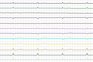 s0190lre-patient052 thumbnail