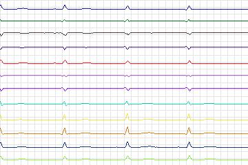 s0192lre-patient054 thumbnail