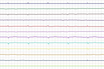 s0194lre-patient055 thumbnail
