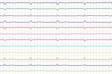s0197lre-patient054 thumbnail
