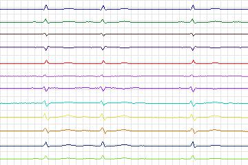 s0213lre-patient051 thumbnail